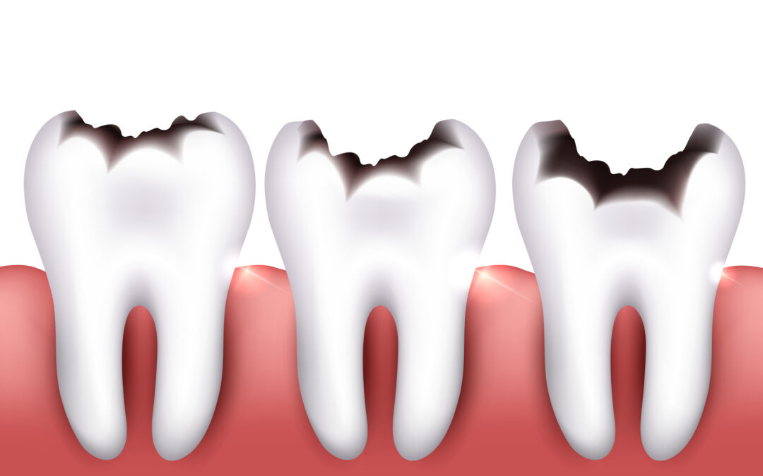 How Fast Do Cavities Grow?
