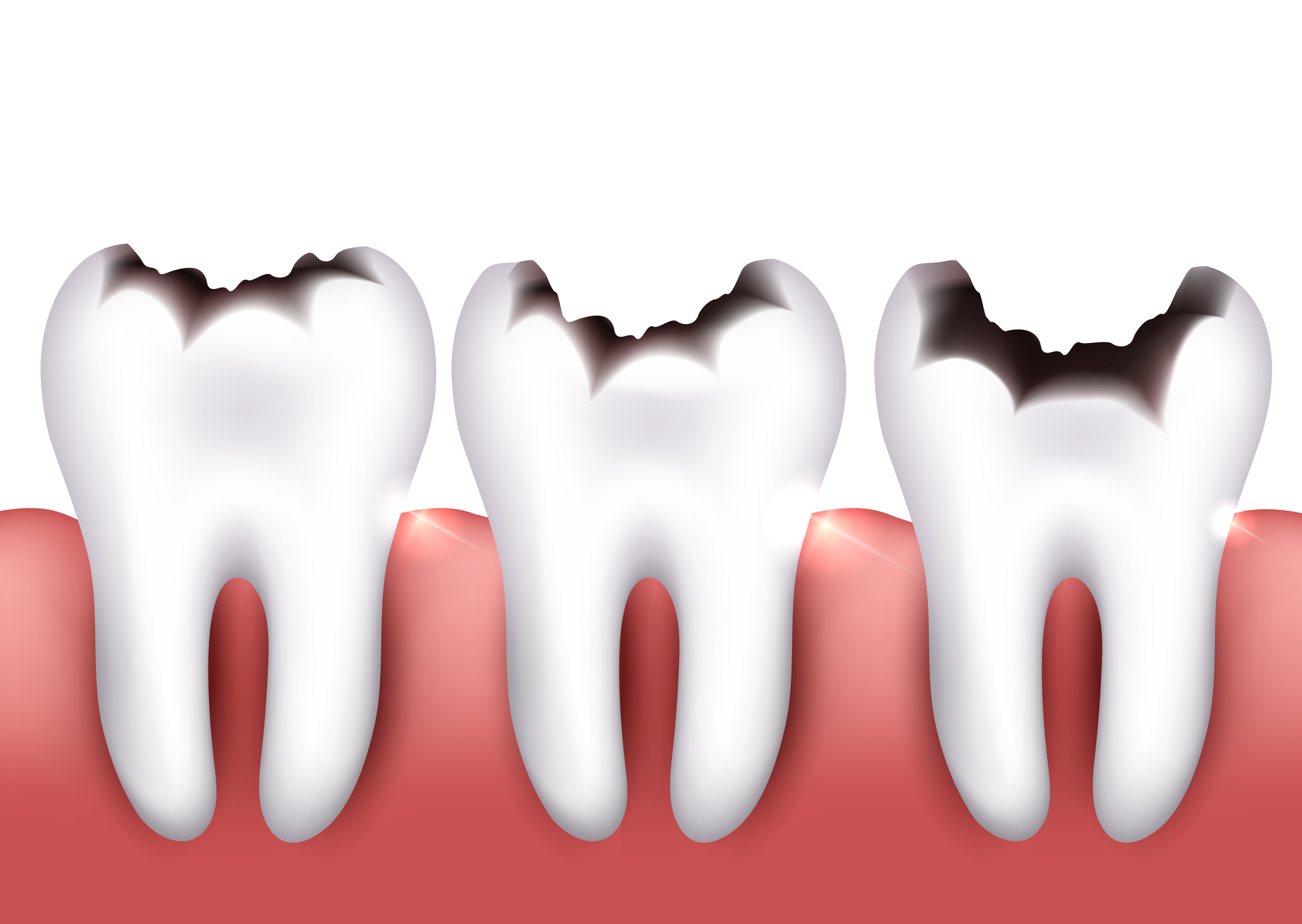 concept image of the progession of dental decay to answer the question, "how fast do cavities grow?"